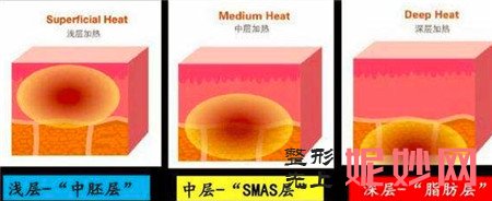 热拉提是溶脂还是收紧脂肪？是否可以改善双下巴？