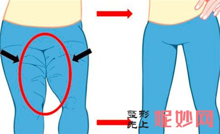大腿吸脂术有什么样的特点？做大腿吸脂的价格贵不贵？