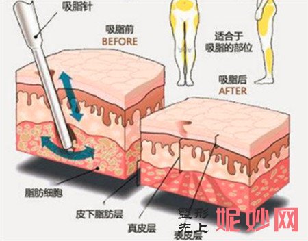大腿吸脂术有什么样的特点？做大腿吸脂的价格贵不贵？