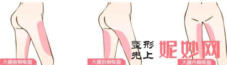 大腿吸脂有哪些部位？术后多久能恢复？
