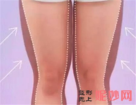 大腿吸脂有哪些部位？术后多久能恢复？