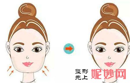 面部吸脂有什么好处？价格是多少？多久才能恢复？