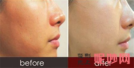 水光*的优势是什么？具有哪些功效？