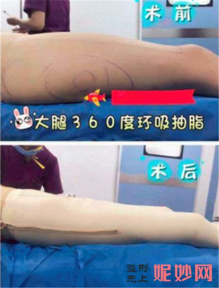 大家常说的大腿环吸，那8个部位分别在哪里?