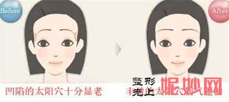 丰太阳穴的方法主要有哪几种？有什么注意事项？
