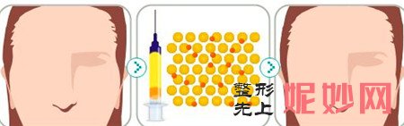 丰太阳穴的方法主要有哪几种？有什么注意事项？
