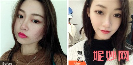 四川友谊医院整形科李继华做磨骨手术的效果怎么样？收费贵不贵？