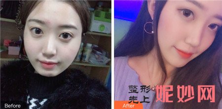四川友谊医院整形科李继华做磨骨手术的效果怎么样？收费贵不贵？