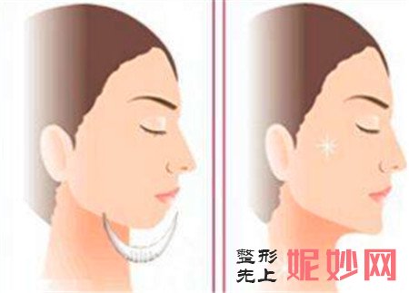 假体隆下巴在哪里做比较好？广州美莱整形找李战强！