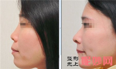 假体隆下巴在哪里做比较好？广州美莱整形找李战强！