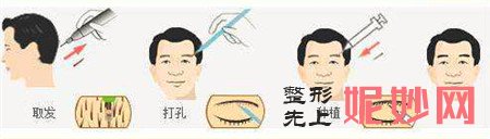 北京瑞丽诗植发医院眉毛种植的优势是什么？眉毛种植要多少钱？