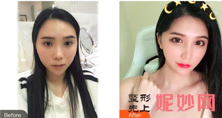 广州紫馨医疗美容医院的金孝宪怎么样？简介,擅长项目,鼻综合案例展示