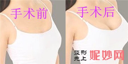 假体隆胸安全吗？价格贵不贵？来看看上海伊莱美整形江华医生的介绍