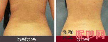 唐山纤嫣整形医院背部吸脂——告别虎背熊腰，背部婀娜更迷人！