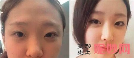 假体丰额头安全吗？成都友谊医院整形外科李发展医生告诉你答案！