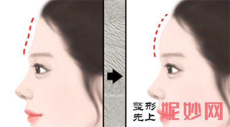 假体丰额头安全吗？成都友谊医院整形外科李发展医生告诉你答案！