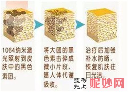绵阳韩美整形做黑脸娃娃效果——先黑后白，光滑肌肤看得见！