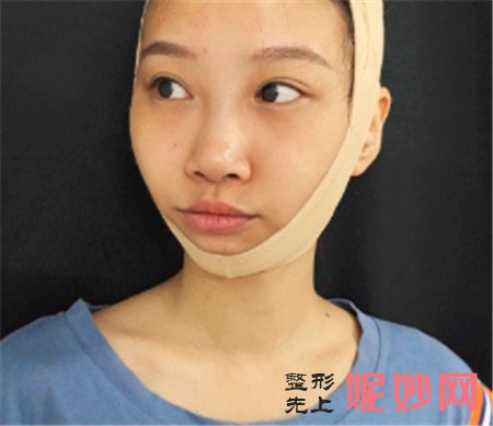 在北京八大处找张智勇医生做的颧骨内推，脸型对称了感觉自己重获新生