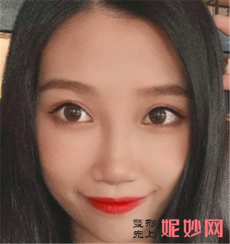 在北京八大处找张智勇医生做的颧骨内推，脸型对称了感觉自己重获新生