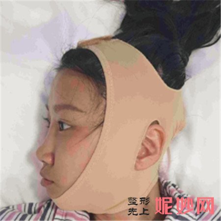 在北京八大处找张智勇医生做的颧骨内推，脸型对称了感觉自己重获新生
