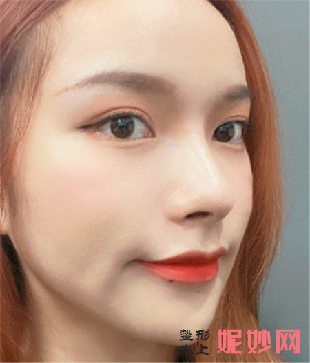 到北京八大处找张智勇医生做了磨骨手术后，脸型越来越好看！