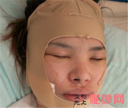 到北京八大处找张智勇医生做了磨骨手术后，脸型越来越好看！