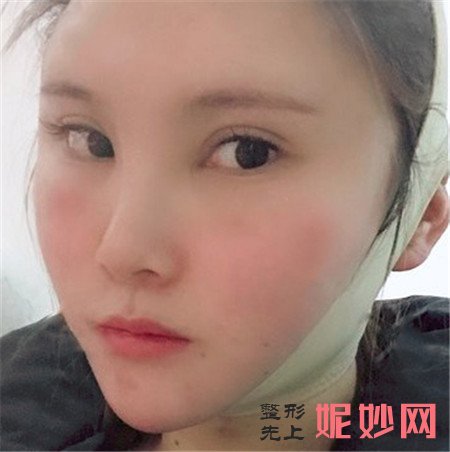 北京八大处的张智勇医生做正颌手术怎么样？真人案例分享