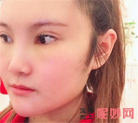 北京八大处的张智勇医生做正颌手术怎么样？真人案例分享