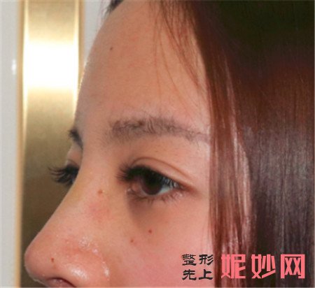 在北京八大处找范飞医生做了鼻综合之后气质都越来越不一样了
