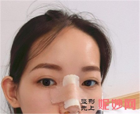 在北京八大处找尤建军医生做了鼻综合手术，弧度超满意！