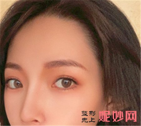 在北京八大处找尤建军医生做了鼻综合手术，弧度超满意！