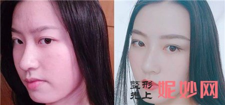 八大处张智勇颧骨内推技术好吗？