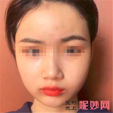 到北京八大处找杨斌医生做了下颌角整形后，整个脸部轮廓都匀称了