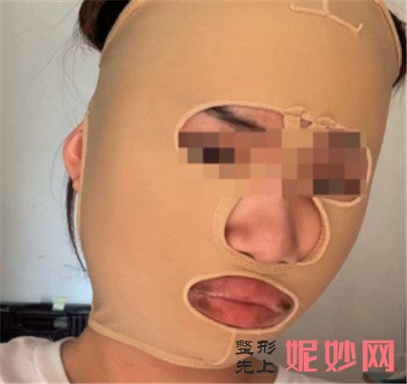 到北京八大处找杨斌医生做了下颌角整形后，整个脸部轮廓都匀称了