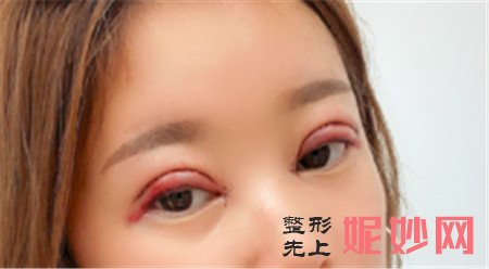 在北京八大处找唐晓军医生做的双眼皮，术后的眼睛看上去特别自然