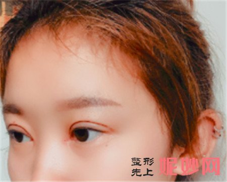 在北京八大处找唐晓军医生做的双眼皮，术后的眼睛看上去特别自然
