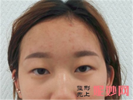 在北京八大处找唐晓军医生做的双眼皮，术后的眼睛看上去特别自然