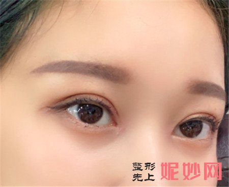 在北京八大处找唐晓军医生做的双眼皮，术后的眼睛看上去特别自然