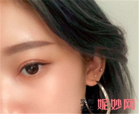 在北京八大处找唐晓军医生做的双眼皮，术后的眼睛看上去特别自然
