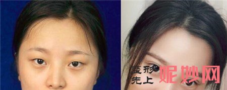 王永前做双眼皮好吗？