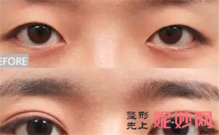 侯典举做双眼皮怎么样？