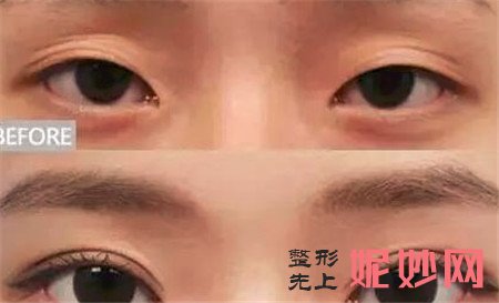 侯典举双眼皮修复怎么样？