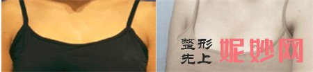穆大力隆胸怎么样？