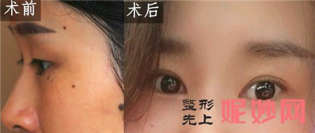 八大处刘立强做双眼皮怎么样？