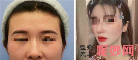 八大处隆鼻哪个医生好？