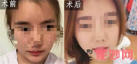 八大处牛峰削骨手术做得怎样？