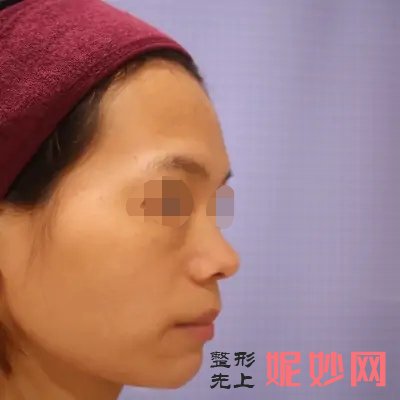 上海华美哪个医生做鼻子好？案例+价格