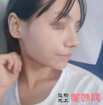 上海华美哪个医生做鼻子好？案例+价格