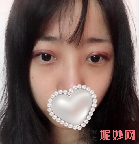 广州安丽维整形割双眼皮怎么样？双眼皮效果图对比！