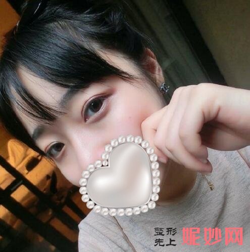 广州安丽维整形割双眼皮怎么样？双眼皮效果图对比！